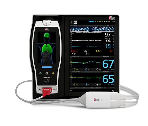 Root with O3 Regional Oximetry