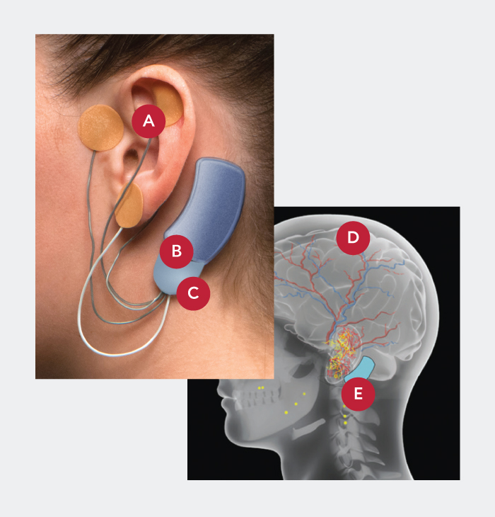 A percutaneous auricular nerve stimulation system (NSS-2 Bridge