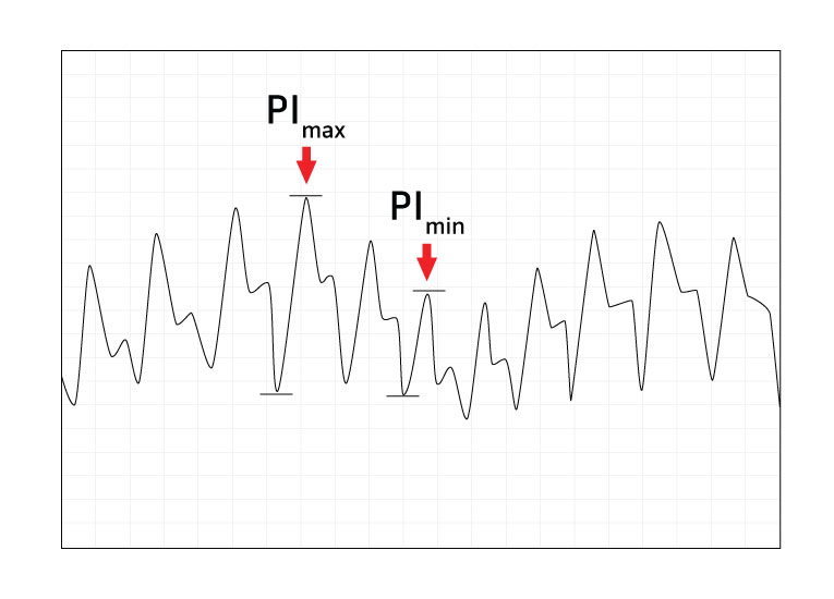 Perfusion Index Chart